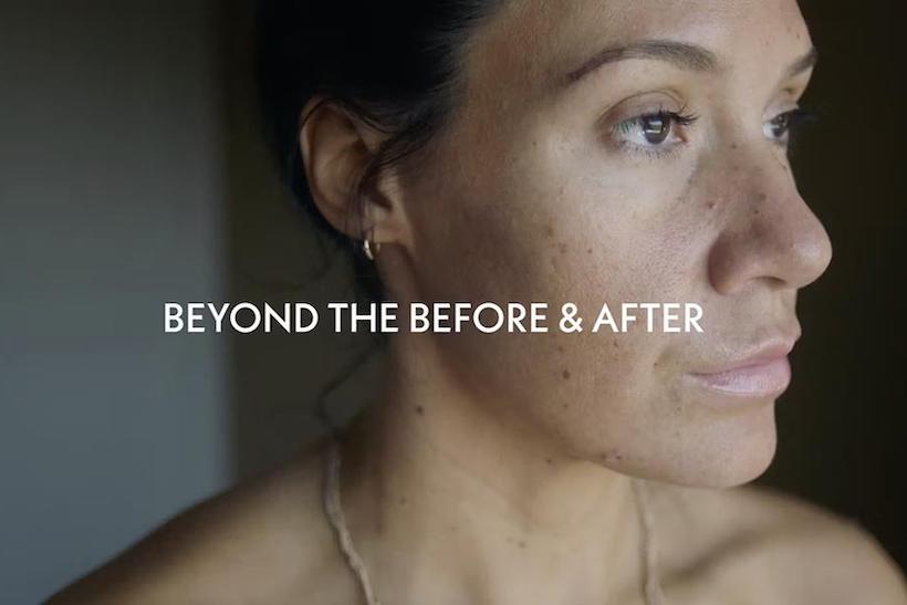 Screenshot from AbbVie's aesthetic surgery campaign